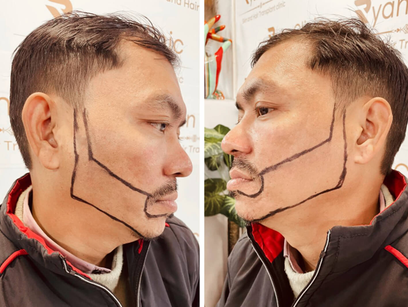 Full beard restoration results